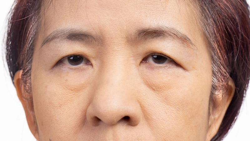 sụp mí mắt lão hóa