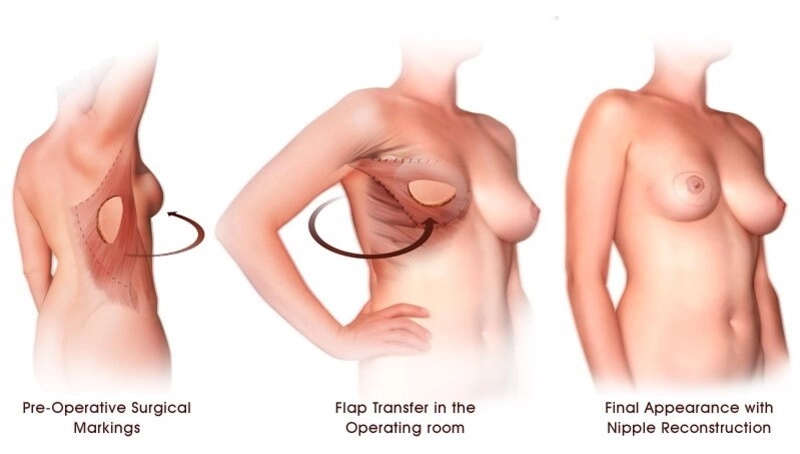 tái tạo núm vú từ vùng da xung quanh