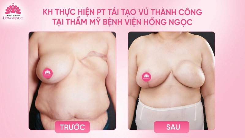 tái tạo vú