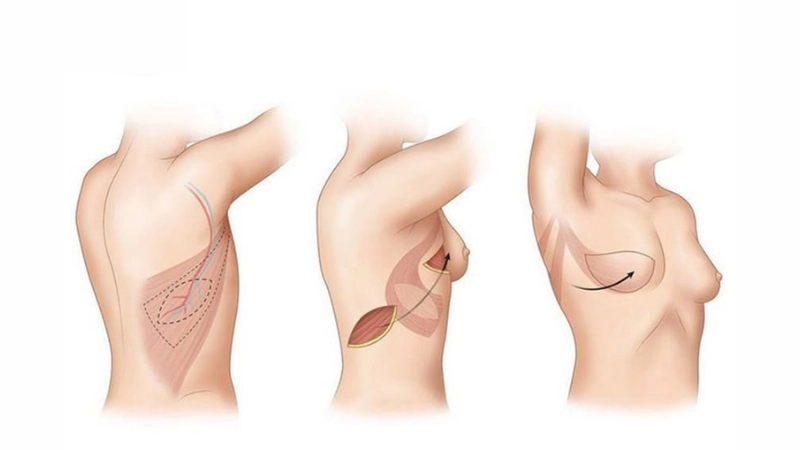 tái tạo vú