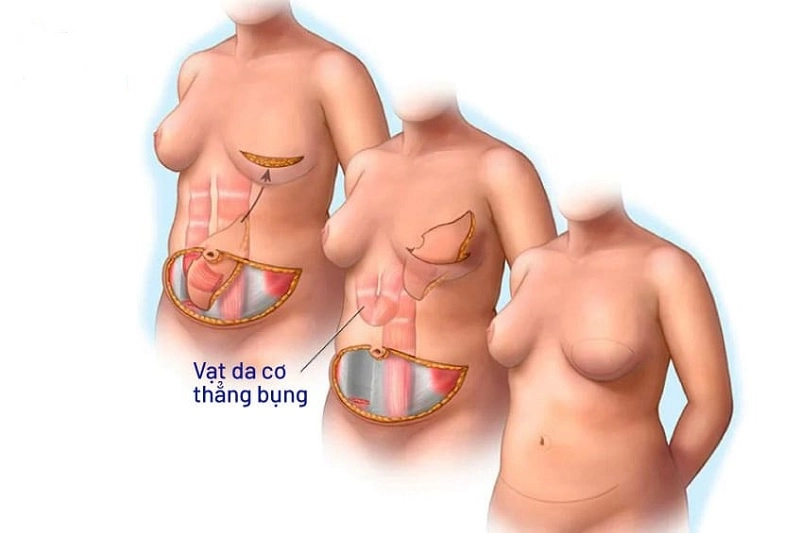 tái tạo vú bằng vạt da bụng là gì