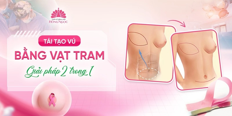 tái tạo vú vạt tram