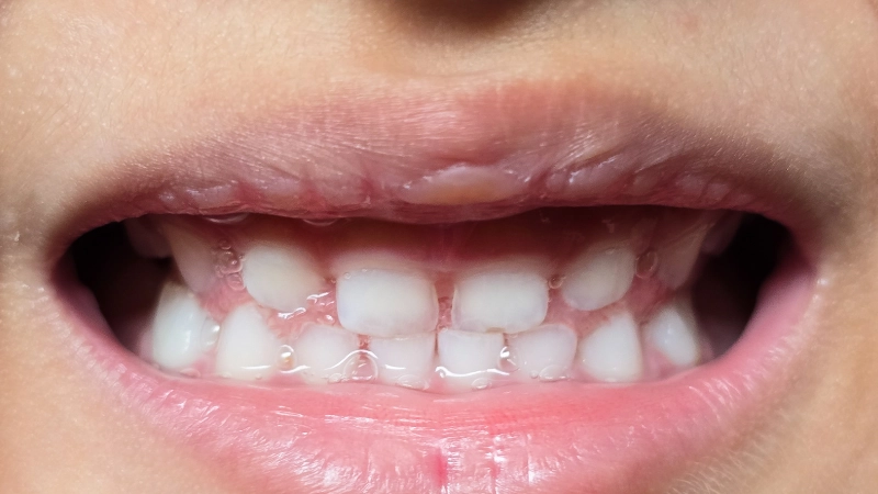 tầm quan trọng của việc chăm sóc răng sữa cho bé