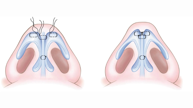 tạo hình đầu mũi