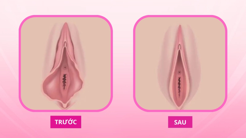 tạo hình môi bé