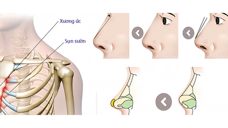 tạo hình mũi