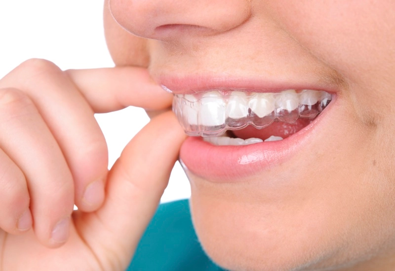 Các phương pháp tẩy trắng răng