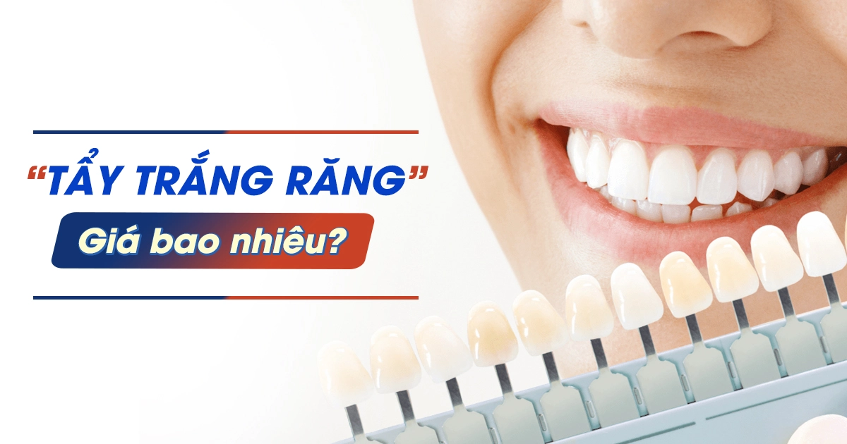 Tẩy trắng răng giá bao nhiêu?