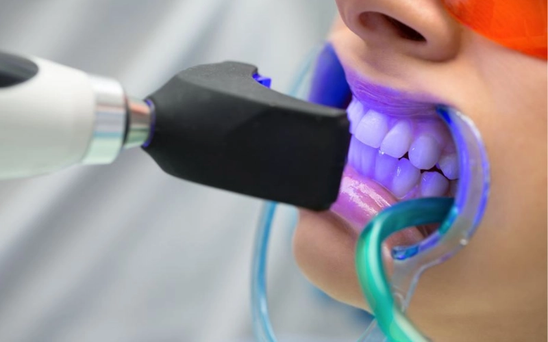 Hình ảnh minh họa chiếu chiếu đèn Plasma khi tẩy trắng răng
