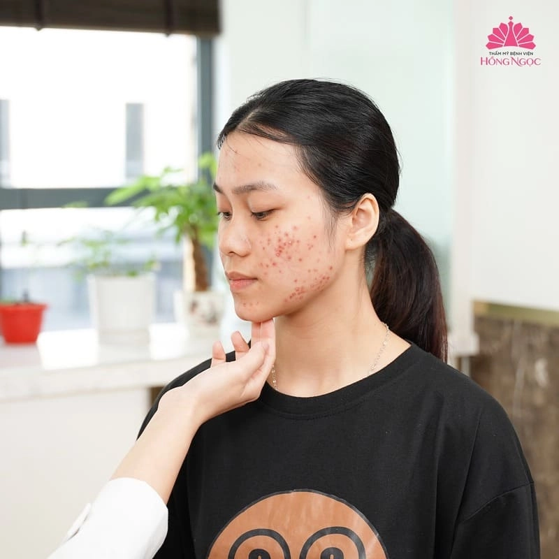 thăm khám điều trị mụn