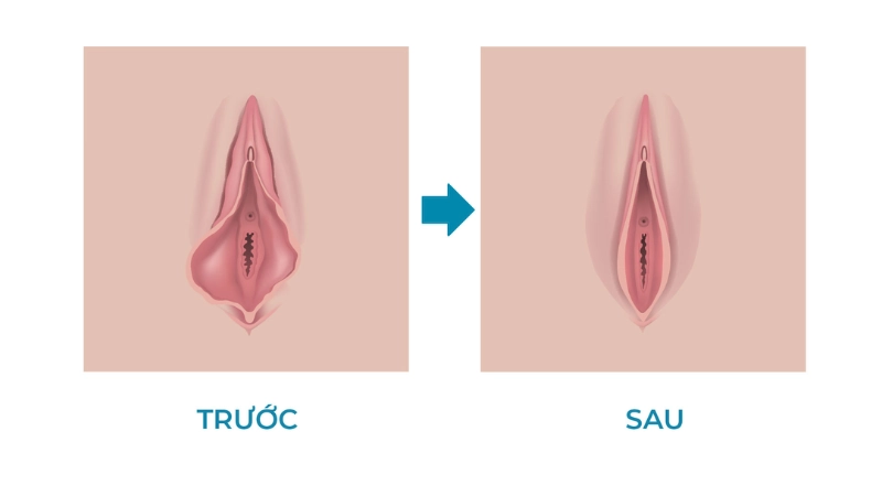 phẫu thuật thẩm mỹ vùng kín
