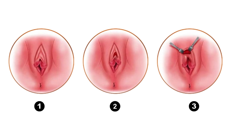 phẫu thuật thẩm mỹ vùng kín