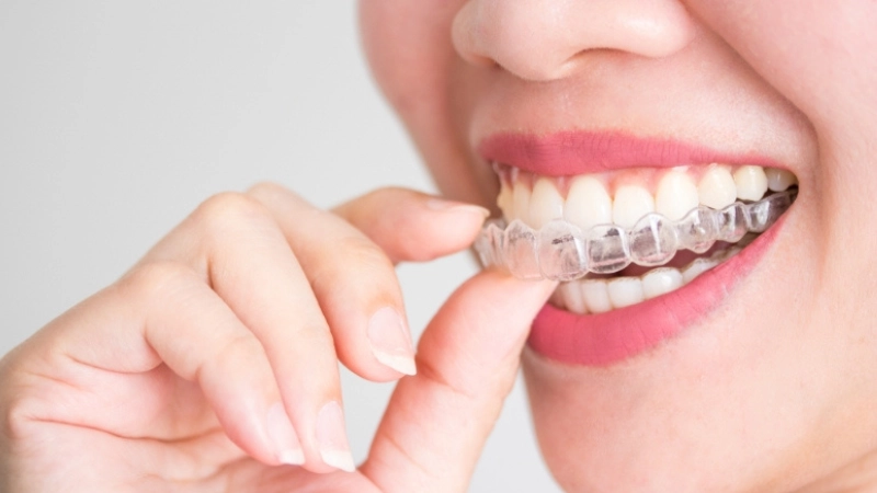 chinh-nha-invisalign-nieng-rang-vo-hinh-tu-tin-ngay-ca-khi-dang-nieng