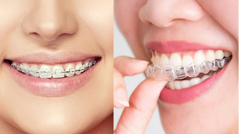 chinh-nha-invisalign-nieng-rang-vo-hinh-tu-tin-ngay-ca-khi-dang-nieng