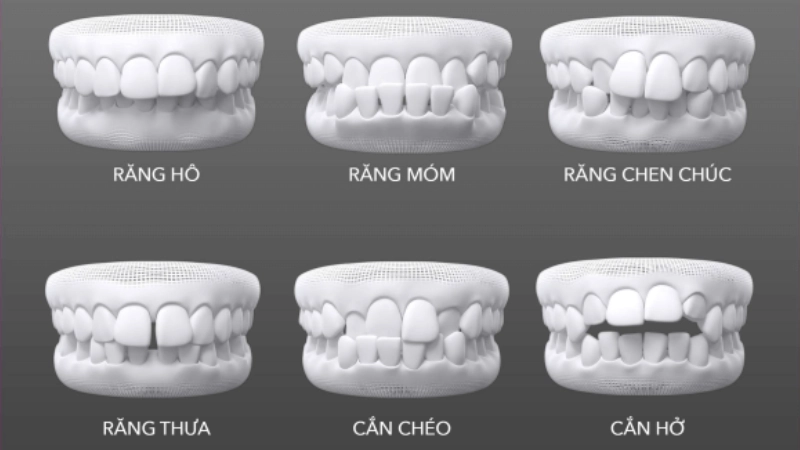 chinh-nha-invisalign-nieng-rang-vo-hinh-tu-tin-ngay-ca-khi-dang-nieng