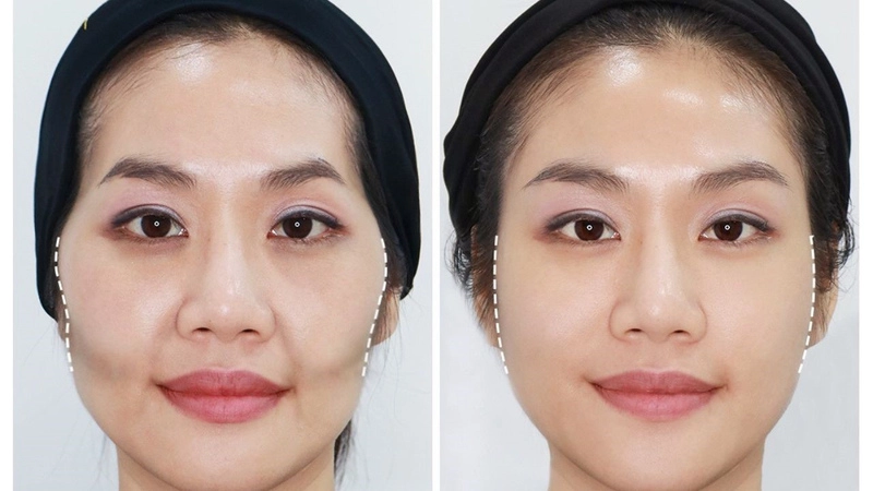 ha-go-ma-bi-kip-giup-khuon-mat-tre-trung-hơn