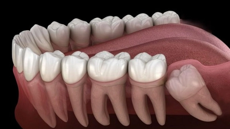 nen-nho-rang-khon-vao-thoi-diem-nao-trong-nam