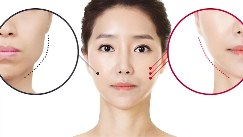 got-ham-v-line-tai-dinh-hinh-khuon-mat-chuan-ti-le-vang