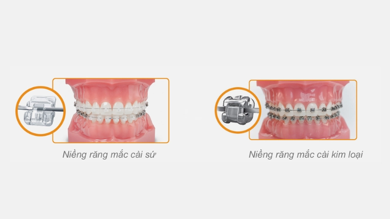 nen-chon-nieng-rang-mac-cai-kim-loai-hay-nieng-rang-mac-cai-su