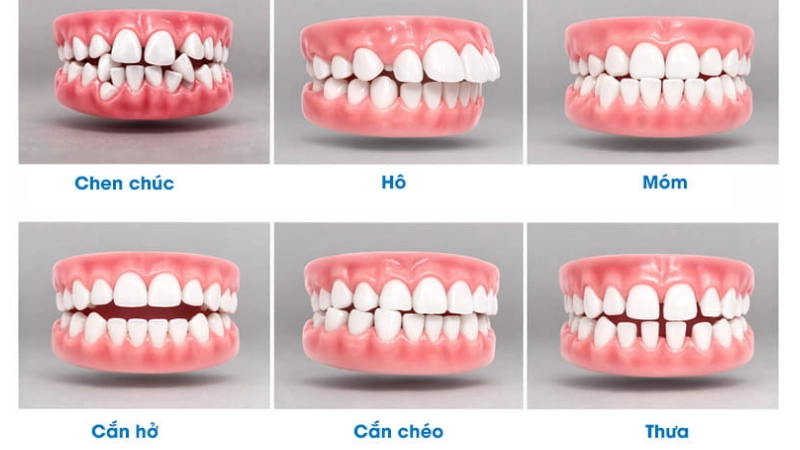 chinh-nha-cho-tre-em-can-thiep-dung-thoi-diem-nu-cuoi-phat-trien-toan-dien