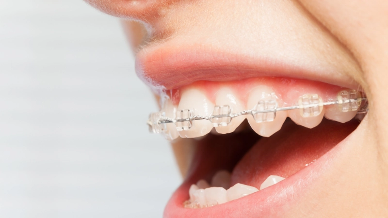 nen-chon-nieng-rang-mac-cai-kim-loai-hay-nieng-rang-mac-cai-su