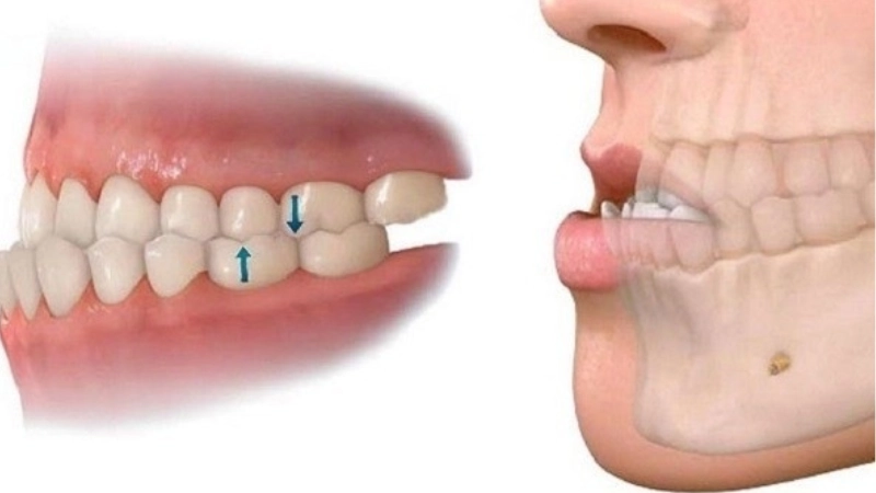 chinh-hinh-ham-mom-giai-phap-toi-uu-cho-khop-can-chuan-xac