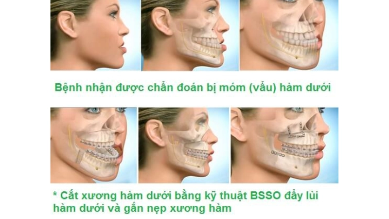 chinh-hinh-ham-mom-giai-phap-toi-uu-cho-khop-can-chuan-xac