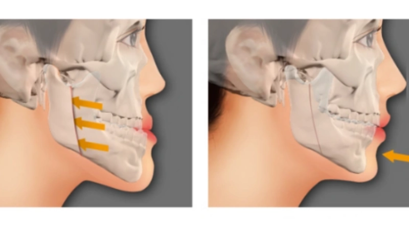 chinh-hinh-ham-mom-giai-phap-toi-uu-cho-khop-can-chuan-xac