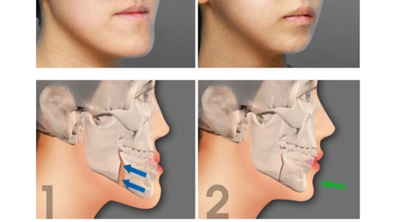 chinh-hinh-ham-mom-giai-phap-toi-uu-cho-khop-can-chuan-xac