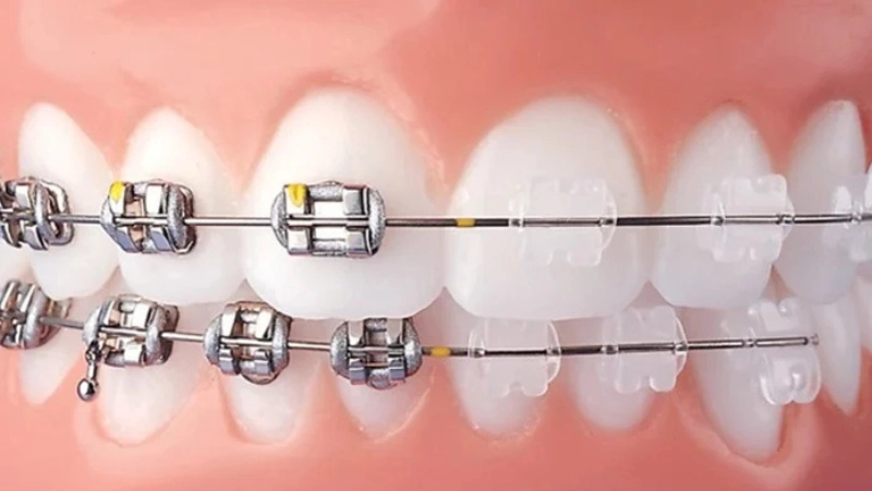 nen-chon-nieng-rang-mac-cai-kim-loai-hay-nieng-rang-mac-cai-su