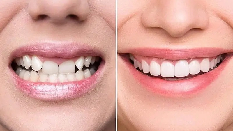 nieng-rang-nu-cuoi-toa-sang-tu-tin-trong-moi-khoanh-khac