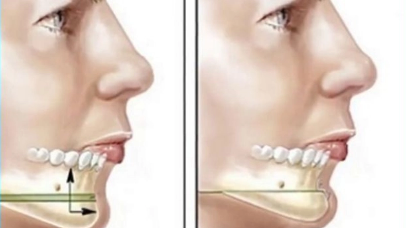 truot-ham-giai-phap-cai-thien-khop-can-va-hai-hoa-khuon-mat