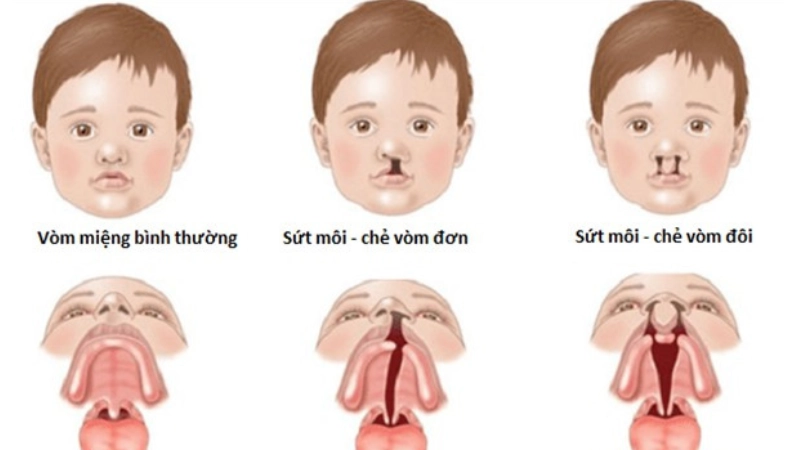 Chỉnh hình hàm mặt dị tật bẩm sinh