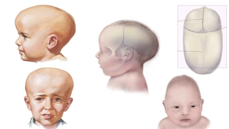 Chỉnh hình hàm mặt dị tật bẩm sinh