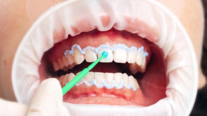 tay-trang-rang-bi-quyet-cho-nu-cuoi-tu-tin-trang-sang