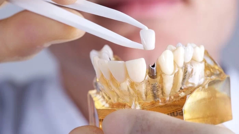 cham-soc-rang-implant-va-ve-sinh-dung-cach-la-nhu-the-nao