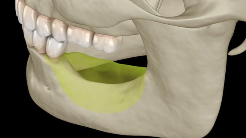 trong-rang-implant-giai-phap-cho-nguoi-bi-mat-rang-lau-nam