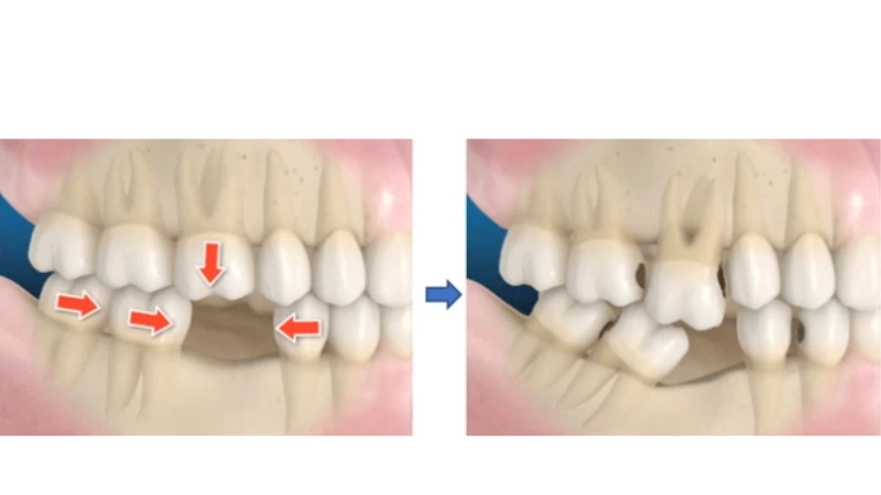 mat-rang-khong-con-la-noi-lo-khi-co-giai-phap-trong-implant