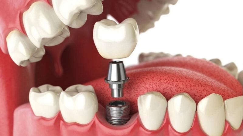 Hình ảnh minh họa trồng răng Implant