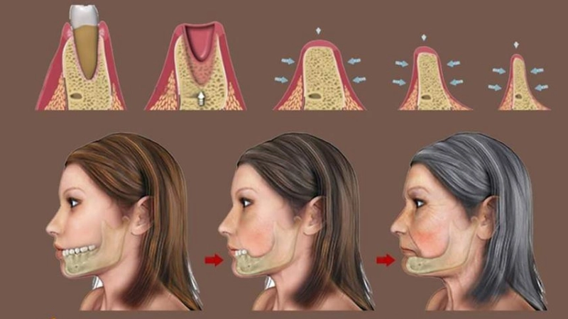 trong-rang-implant-bao-ve-suc-khoe-rang-mieng-lau-dai