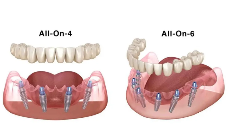 trong-rang-implant-giai-phap-cho-nguoi-bi-mat-rang-lau-nam