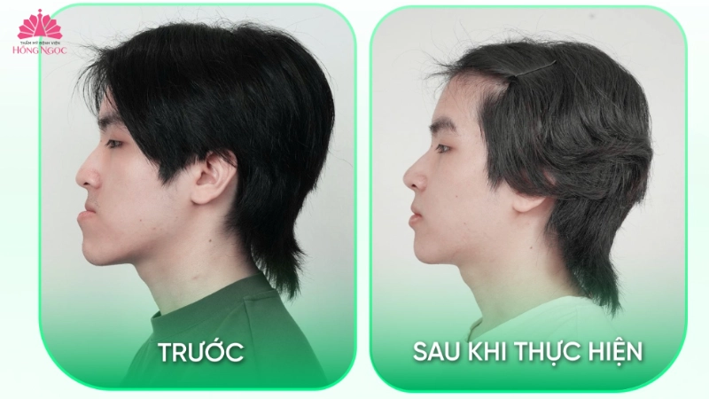 chinh-hinh-ham-mom-giai-phap-toi-uu-cho-khop-can-chuan-xac