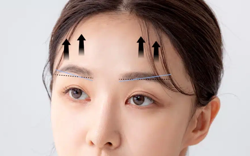 Ai nên thực hiện căng da trán?
