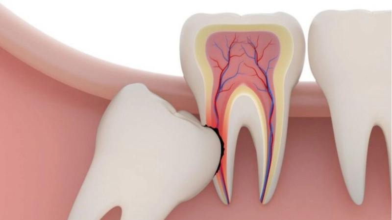 nho-rang-khon-moc-ngam-an-toan-hieu-qua-voi-ky-thuat-xam-lan-toi-thieu