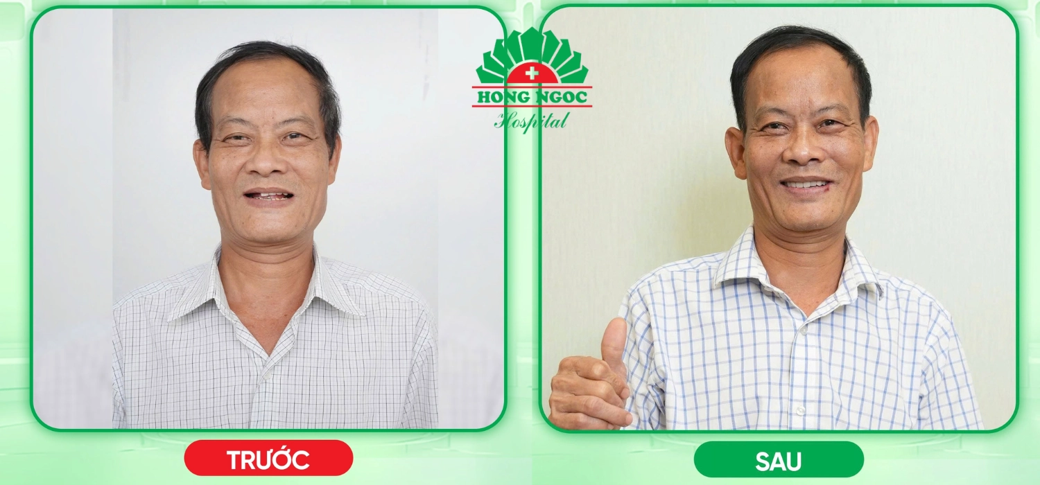 Trồng răng Implant áp dụng cho những trường hợp nào?