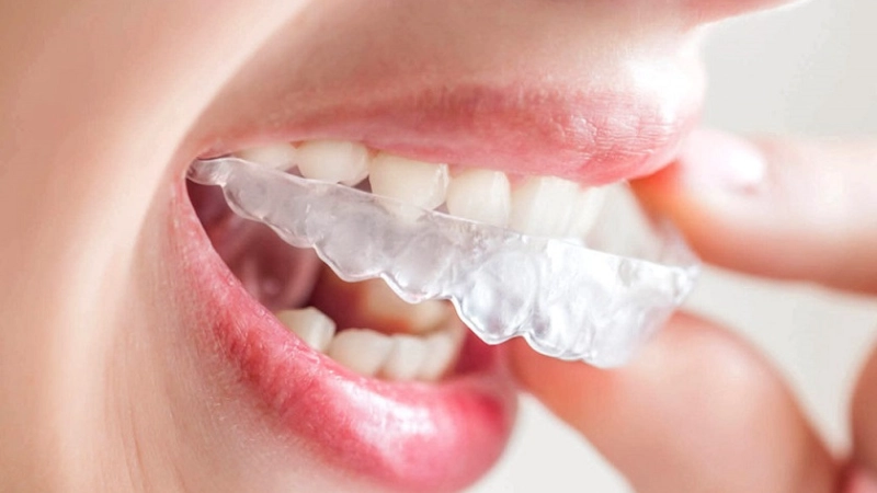 nieng-rang-tre-em-thoi-diem-vang-de-co-ham-rang-khoe-dep