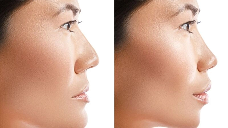 thời gian duy trì nâng mũi bán cấu trúc