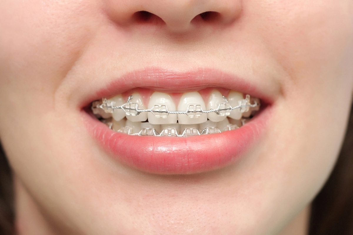 Thời gian niềng răng mắc cài sứ