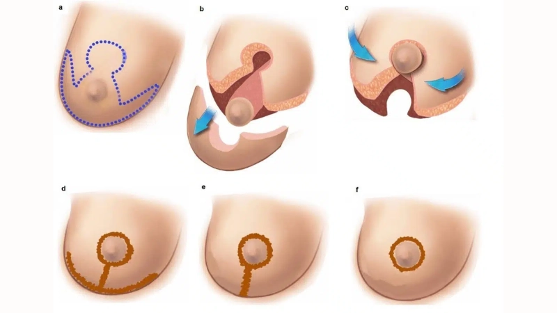 thu gọn ngực phì đại