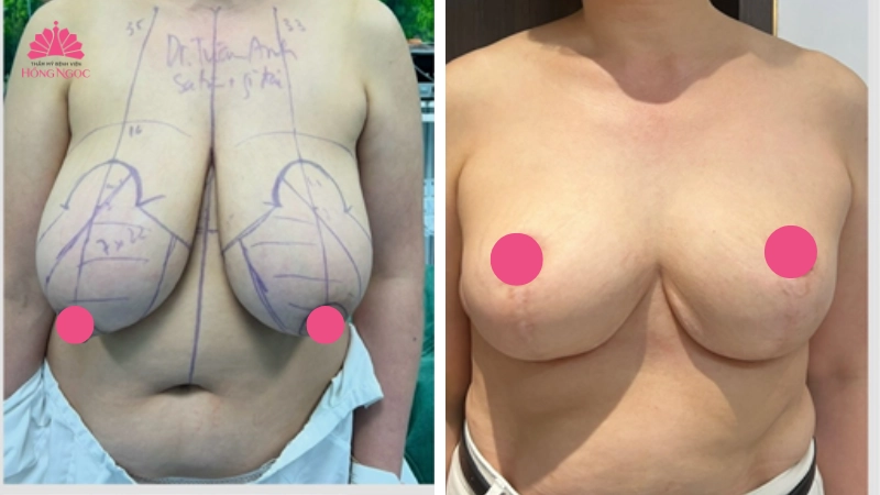 thu gọn ngực phì đại